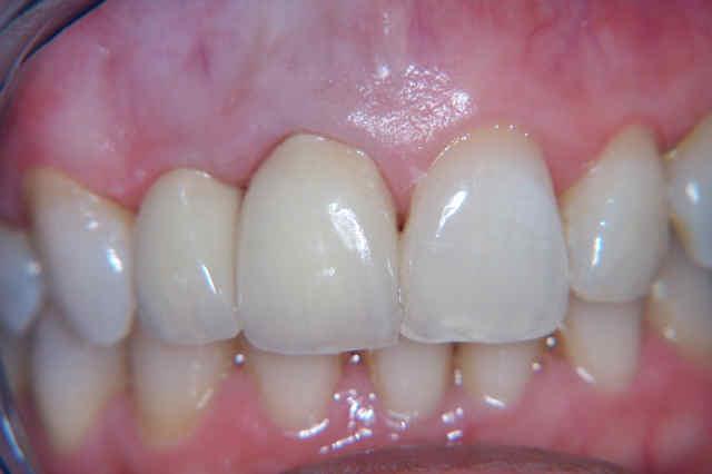 Case Crowns B After