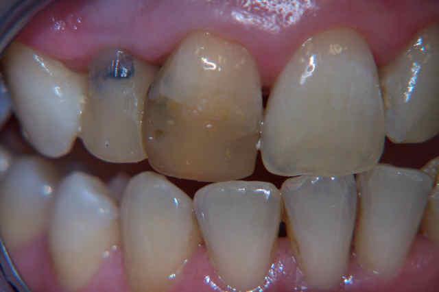 Case Crowns B Before