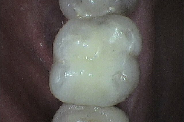Case Whitefilling A After