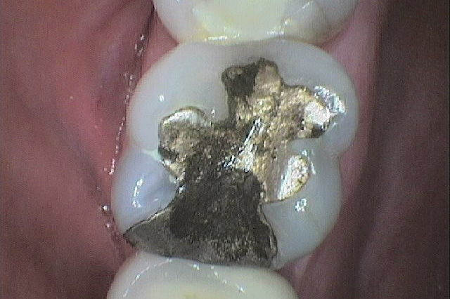 Case Whitefilling A Before