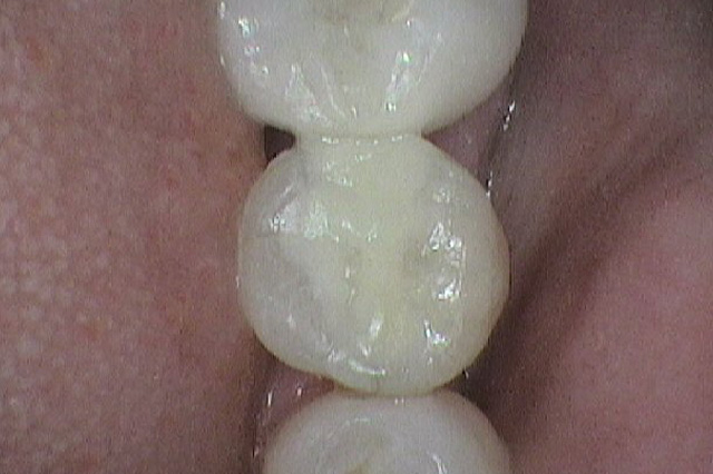 Case Whitefilling B After