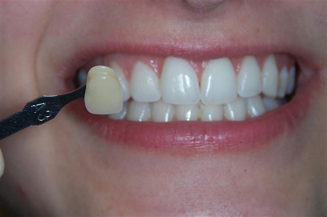 Case Homewhitening A After