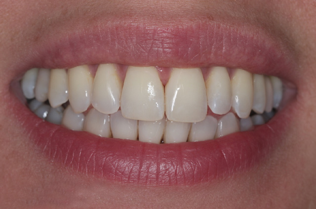 Invisalign A After